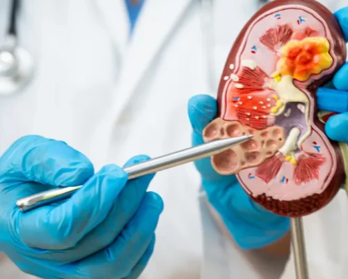 Pedra nos rins: Calor do verão aumenta em até 30% o risco de crises, entenda os perigos e como se prevenir