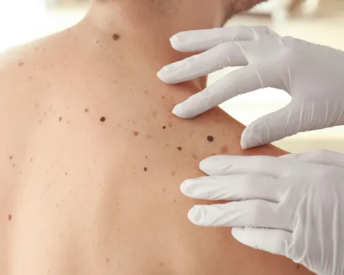 Alerta de Saúde: Casos de Câncer de Pele Disparam de 4 Mil para Mais de 72 Mil em Uma Década no Brasil