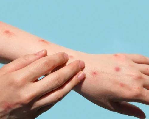 Mpox: Saiba Como Identificar os Sintomas e Evitar a Transmissão Doméstica, Especialistas Alertam Sobre Diagnóstico Precoce