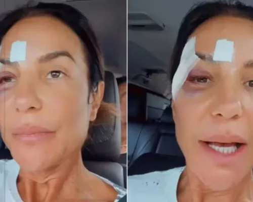 Cirurgia de Ivete Sangalo: Cantor baiana de 53 anos passa por procedimento neste domingo, Portal Léo Dias divulga informação