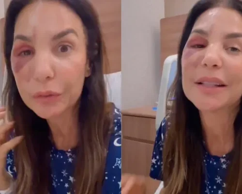 Ivete Sangalo tranquiliza fãs após cirurgia no maxilar: ‘Livramento’ após queda e desmaio