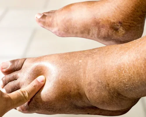 Corpo Inchado: Entenda o Edema Periférico, Causas, Sintomas e Como Evitar o Inchaço nas Pernas e Pés