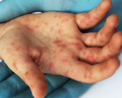 Alerta de Saúde: Ministério da Saúde confirma novo caso de Sarampo no Rio de Janeiro em 2026, reforça vacinação