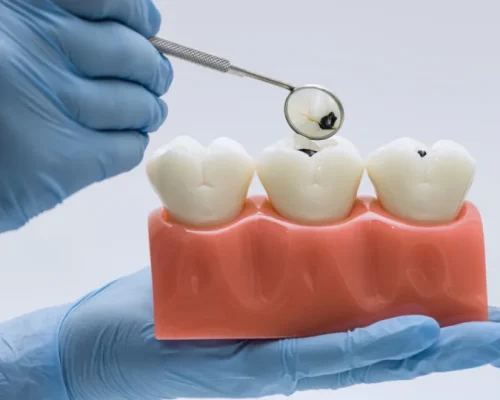 Ataque Silencioso: Alimentos e Bebidas Comuns Destroem o Esmalte dos Dentes, Mesmo com Boa Higiene Bucal