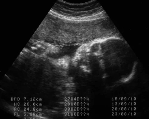 Extrema direita no Chile propõe lei para obrigar mulheres a ouvir batimentos do feto antes do aborto